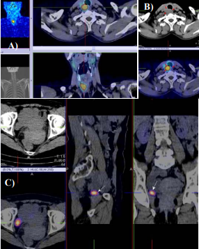  F/39 year-old with MTC after total thyroidectomy with increased calcitonin level – 95pg/ml. SPECT-CT with 99mTc-Tektrotyd showed local disease recurrence  with intensive tracer uptake and retrotracheal localization (A,B). High activity was imaged in the region of a benign ovary cyst. (C).