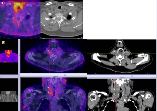  M/61year-old with MTC after thyroidectomy and increased level of Calcitonin 1056 pg/ml. SPECT-CT with 99mTc-Tektrotyd was positive for soft-tissue tumor  formation in the thyroid bed with retrotracheal extension(A), significant for local recurrence infiltrated surrounding tissues, laterocervical lymph nodes on the right (B)  and secondary osteolytic destruction of Th1 and Th2(A).