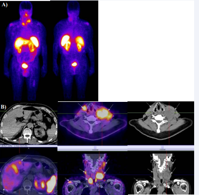 M/72 year-old with MTC after total thyroidectomy and cervical lymph node dissection– pT3pN1aM0 with increased calcitonin level – 5496pg/ml. Whole body  scan followed by SPECT-CT with 99mTc-Tektrotyd showed exact topographic disease extension in the region of the thyroid bed, bilateral laterocervical, mediastinal and  supraclavicular bilateral enlarged lymph nodes, lung secondary lesions, bone metastases in bilateral shoulder joints, left femur, liver metastases with high tracer uptake  (A,B).