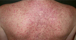  Generalized skin rash.