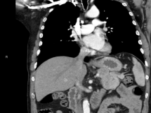 Pancreatic mass with lymph node involvement.