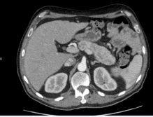  Pancreatic mass with local tissue invasion.