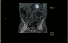 Positive Octreotide scan.