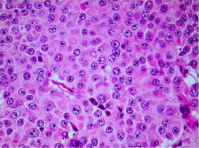 Tumor in high power modest nuclear pleomorphisim, prominent  nuclei with abundant granular cytoplasm.