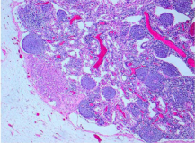  Lymph node show lymphocytes and aggregates of tumor cells