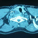 Tomographic scan of the neck showing a right parathyroid mass.