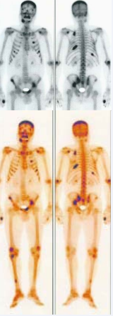 Figure 2 Initial bone scan: multiple hyperactive foci that can be associated  with diffuse metastatic calcifications