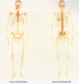 Bone scan 6 months after surgery a radiological cleanup