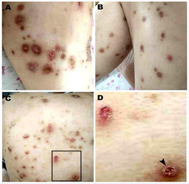 Pigmentation lesions.