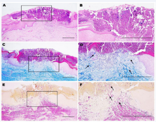 Lymphocytes and infiltration of eosinophil cells.