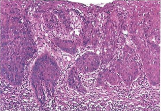 Histological appearance of squamous cell carcinoma.