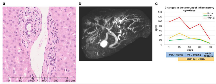 (a) Histopathological features. Liver biopsy shows neutrophilic and monocytic infiltration around the bile duct (hematoxylin-eosin staining).  (b) Imaging study. MRI shows peripheral-dominant dilatation of the intrahepatic bile duct without occlusion. Dilatation is absent in common bile  duct and gallbladder. (c) Changes in inflammatory cytokine levels. Treatment with prednisolone (PSL) at 2 mg/kg/day and mycophenolate mofetil  (MMF)/ ursodeoxycholic acid (UDCA) partially decreased serum levels of interleukin-1a (IL-1a), interleukin-6 (IL-6), and tumor necrosis factor-?  (TNF-?). The levels were further decreased after a 3-day treatment of methylprednisolone (mPSL).