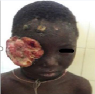 Eyelid SCC on a child during xeroderma pigmentosum.