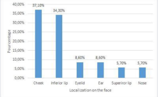 Location of SCC on the face.