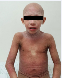Figure 2 Photograph of the patient demonstrating generalized  ichthyotic erythroderma, alopecia, no eyebrows, and no eyelashes  with angular cheilitis and normal teeth.
