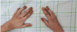 Ectrodactyly in the right hand with Lobster’s claw  malformation. Note the dystrophic fingernails with pachyonychia.