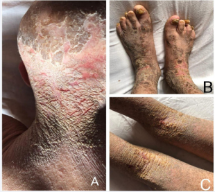 Lamellar ichthyosis characterized by large, thick,  hyperpigmented and quadrangular scales, separated by narrow  fissures predominant over the scalp (A), lower legs, feet (B) and the  flexural surfaces (C).