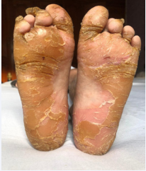 Diffuse plantar keratoderma with large fissures