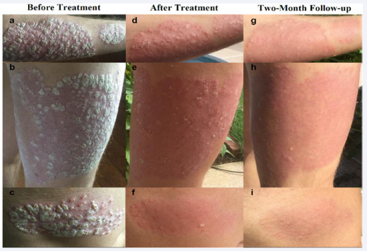 Psoriatic lesions on right upper forearm (a, d, g); right upper thigh (b, e, h); and upper right abdomen (c, f, i) before treatment, after  treatment, and at two-month follow-up, respectively.