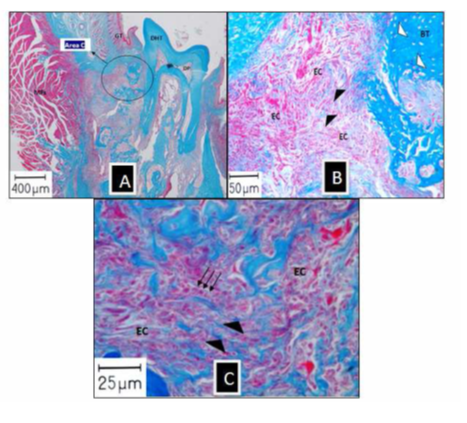 Figure 4: (A): Histological section taken from a test site which clinically showed tumor (*) (orig mag ×2.5), (B): Area “C” under higher magnification showing little bone tissue elements (BT), osteocyte-lacunae features (white triangles), area of dense infiltration with epithelial-like cells (EC) interrupted by fillets of collagen fibers (black triangles) (orig mag ×20), (C): Part of area ”C” under higher magnification showing dense infiltration of undefined epithelial-like cells (arrows) and collagen fibers (triangles) (origmag ×40) (DHT: Dental Hard Tissue, DP: Dental Pulp, GT: Gingival Tissue, MFs: Muscular Fibers) and (Area “C”: The area where collagen sponge with PdSCs was transplanted).