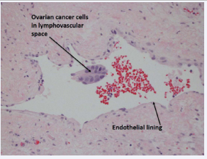 Figure 1a Lymphovascular space invasion in ovary