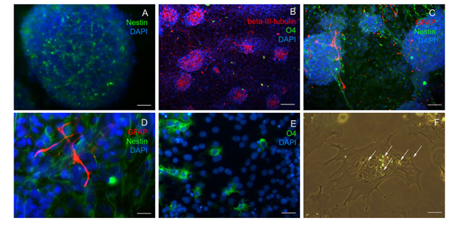 Figure 8: Immunocytochemical phenotyping of cellular preparations. A, B, C – human olfactory lining neural stem cells. D, E - rat embryonic nerve tissue cells. Immunofluorescent analysis using either anti-human or anti-murine antibodies to the neural progenitor cell marker nestin(A, D), neuroblast marker ?-III-tubulin(B), oligodendrocyte marker O4 (B, E), and astrocyte marker GFAP(C, D), with the cellular nuclei counterstained with DAPI. Fluorescence microscopy. F – rat fibroblasts, characteristic absorption of collagenous nanoparticle is indicated with arrows. Fluorescent / dark-field microscopy.  Scale bar 100 ?m (A, B, C); 20 ?m (D, E, F).