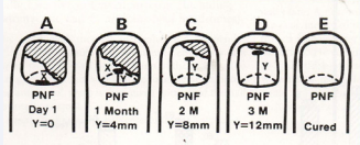 Diagrammatic scheme of what should happen if the drug tested is  clinically effective at that dosing schedule. The drug is deposited at the junction  of the infected nail bed and if effective will not allow the invading organism  continue its movement proximally. This will show as a normal nail bed. In  toenails the growth is one mm per month and in finger nails one mm per week.  The increase in mms of normal nail bed denotes an effective drug . Any decrease  of this progression means the drug is no longer effective. (cortesy Zaias and  Drachman ).