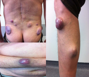 Metastatic cutaneous plasmacytoma localized in lower back,  right leg and right forearm.