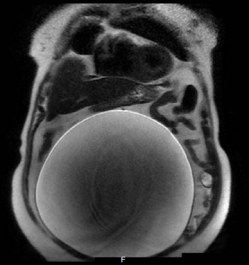 Giant cyst in the MRI image.