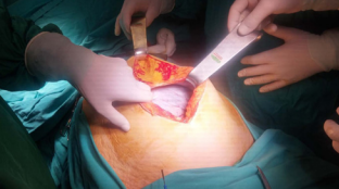 Intraoperative figure of the cyst