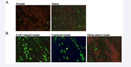 Isolation of microvessels by LCM. (A) Microscopic view (Magn. 40x) of microvessels stained with fluorescein-labeled UEA1 (green) in clinical samples of patients diagnosed with IDC (right side); the patient’s matching normal tissue is shown on the left. (B) Identification of UEA1- labeled microvessels in the IDC samples (right panel) isolated by LCM. The middle panel shows the same section from which the microvessels were removed, while the right panel shows the isolated microvessels on the HS cap