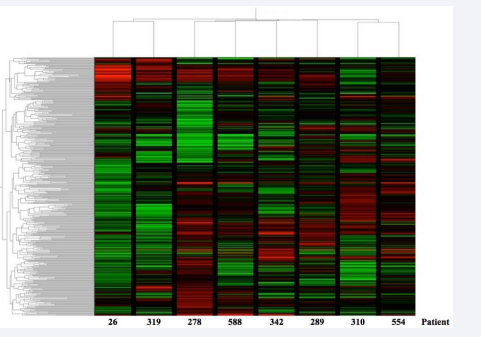 cDNA microarray analysis of the LCM isolated microvessels obtained from eight patients diagnosed with IDC. Two-dimensional hierarchical clustering of statistically significant modulated genes in the tumor microvasculature (up-regulated, red; down-regulated, green) that were identified using ‘Filtering on Volcano plot’. A total of 219 genes (Supplemental Table S1) that were up-regulated in at least 4/8 patients with a 1.3-fold cut-off (P<0.05) were selected. Vertical dendrograms illustrate similarities between gene expression profiles; horizontal dendrograms show similarities between the eight patients (labeled with ‘patient number’). Up-regulated gene set (Supplemental Table S1) was further evaluated for the enrichment of biological processes using the web-based WebGestalt Toolkit (Supplemental Figure S1).