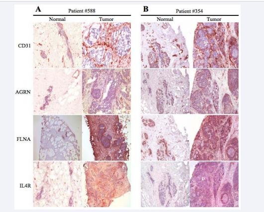 Validation of selected genes at the protein level. Sequential sections of normal (left panels) and tumor (right panels) samples obtained from (A) patient #588 (used for the LCM microarray analysis) and (B) patient #354 (independent patient sample selected using the same criteria as patient #588) were cut and stained for CD31 (identification of blood vessels), and for Agrin (AGRN), Filamin A (FLNA), and Interleukin-4 receptor (IL4R).