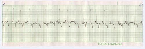  Figure 1 Showing Sinus Tachycardia.