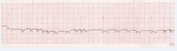  Figure 3 Showing Sinus Arrhythmia