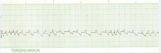  Figure 4 Showing Tachyarrhythmia.