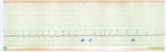 Figure 5 Showing Atrial Fibrillation