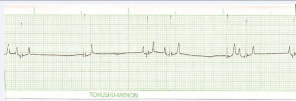  Figure 6 Showing Sinus Arrest