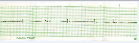  Figure 8 Showing Bradycardia