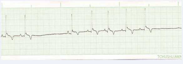  Figure 9 Showing ST elevation.