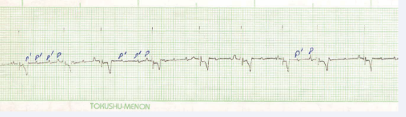  Figure 11 Showing Atrial Paroxysmal Tachycardia.