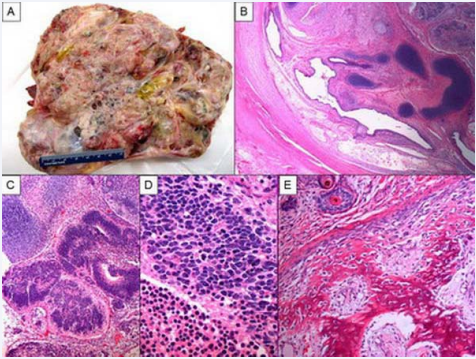 Gross and microscopic findings of the excised mass. Photograph of the excised giant mass. Cut surface shows multilocular mixed solid and cystic mass, predominately cystic, containing greasy material. No mature tissues or organs such as teeth, hair or bone are identified (Figure 1, A). Photomicrograph (original magnification X20; H&E stain) shows mature elements (Figure 1, B). Photomicrograph (original magnification X40; H&E stain) shows immature elements in form of atypical neuroepithelial tissue (Figure 1, C). Photomicrograph (original magnification X60; H&E stain) High power shows malignant neuroepithelial cells with brisk mitosis (Figure 1, D). Photomicrograph (original magnification X60; H&E stain) shows malignant osteoid (Figure 1, E).