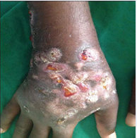 Showing multiple nodules with discharging sinuses over the dorsum  of right hand with induration and swelling of the hand.