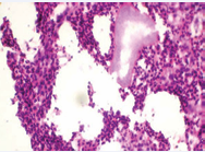Histopathological examination (H&E 10X) showing pale blue colonies  of nocardia with surrounding granulation tissue.