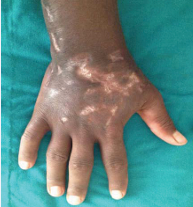 Showing complete subsidence of nodules and sinuses with residual  scarring.