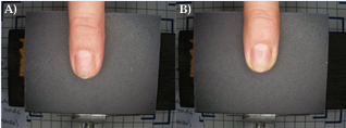 Onychoschizia still present in a fingernail treated with the insoluble  chitosan nail lacquer (b) compared to baseline (a) after 4 weeks of treatment