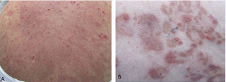 IgG/ IgA Pemphigus. (A) Numerous erythematous papules and  plaques with overlying erosions and small vesicles involving the trunk and  proximal extremities. Serum crust is present. (B) Magnified view of papules and  plaques.