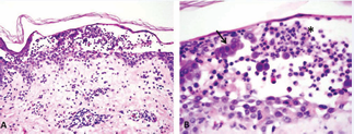 IgG/IgA Pemphigus. (A) Intraepidermal vesicle with acantholysis  in the superficial epidermis and neutrophilic aggregates. H&E stain, 10x  magnification. (B) Magnified view demonstrating intact acantholytic  keratinocytes (black arrow) and neutrophilic aggregates (asterisk). H&E stain,  40x magnification.