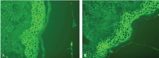 IgG/IgA Pemphigus. Direct immunofluorescence testing for IgA and  IgG performed following a perilesional biopsy. (A) Intercellular deposits of IgA.  (B) Intercellular deposits of IgG showing greater staining intenstity with IgG  compared to IgA. Intercellular C3 deposition is seen in the lower portion of the  epidermis. Direct Immunofluoresence stain, 40x magnification.
