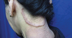 Large plaque of the back of the neck with elevated borders measuring  10 cm
